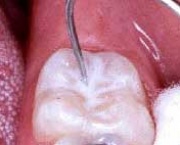 Dente protegido com selante de fissuras Dente protegido com selante de fissuras